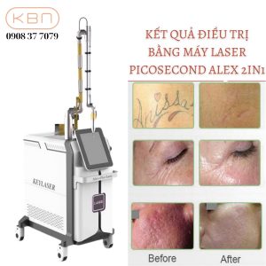 may-laser-picosecond-alex-2in1-chat-luong