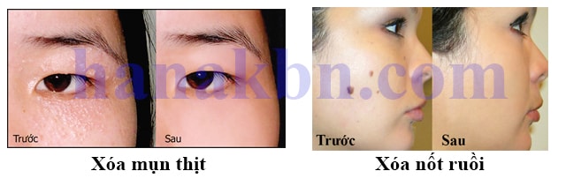 may laser co2, máy trị mụn rỗ, may laser co2 fractional