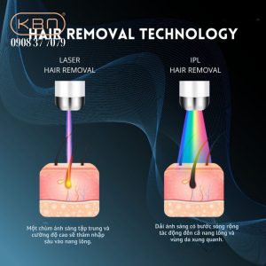 co-che-triet-long-bang-laser