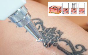 Xóa xăm bằng công nghệ laser đang được nhiều người ưa chuộng
