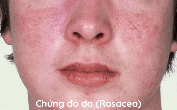 Các triệu chứng thường gặp đó là đỏ bừng mặt, nổi lên, mụn đỏ, đỏ mặt, khô da và da trở nên nhạy cảm