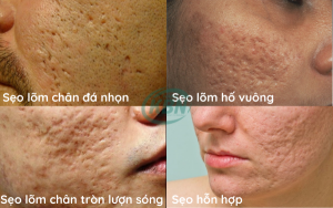 Các loại sẹo rỗ thông thường