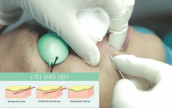 Kỹ thuật này sẽ dùng một dụng cụ sắc nhọn đi vào trong da để cắt mô xơ của sẹo rỗ