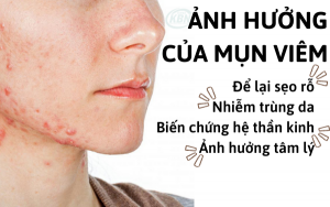 Các ảnh hưởng của mụn nếu không điều trị mụn đúng cách