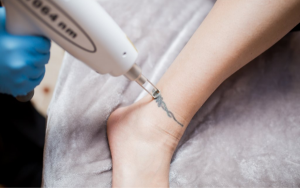 Loại bỏ hình xăm laser là phương pháp hiệu quả, an toàn