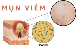 Vi khuẩn P.Acnes là nguyên nhân chính gây nên mụn viêm