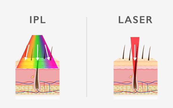 Hình ảnh so sánh công nghệ triệt lông IPL vs Laser