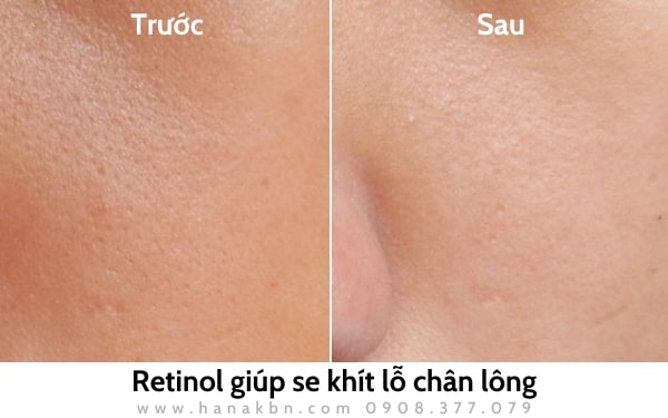 Retinol sẽ giúp se khít lỗ chân lông, mịn màng da