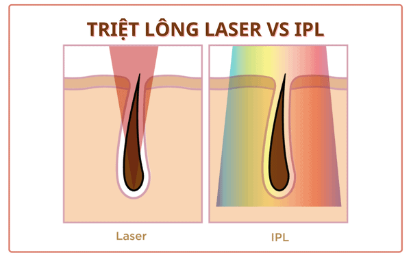 So sánh triệt lông laser và IPL