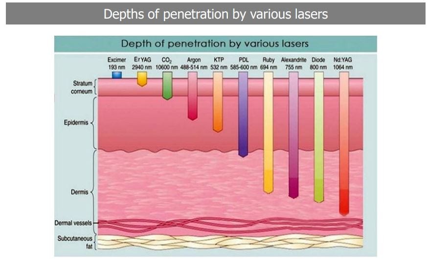 Độ sâu của tia laser Q-Switched ND Yag