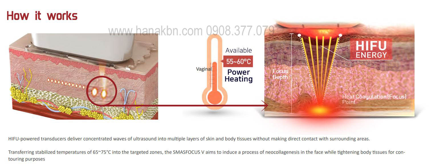 Máy HIFU sẽ hoạt động bằng cách nhắm mục tiêu vào các lớp sâu trong da. Giúp tăng cường sản xuất collagen mới và tạo collagen ngay tại nguồn