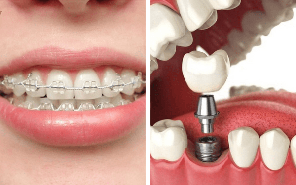 Nhà sản xuất khuyến cáo không nên sử dụng điện di khi trên mặt có kim loại hay niềng răng, implant