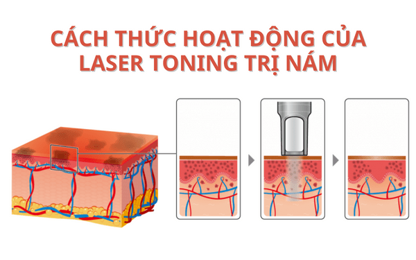 Nguyên lý hoạt động của laser toning không gây tổn thương da