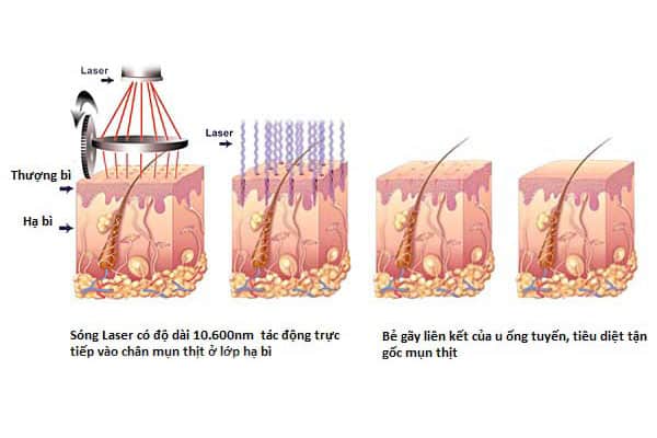 Nguyên lý sử dụng laser co2 trong điều trị mụn