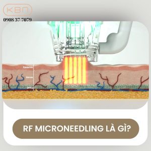 rf-microneedling-la-gi