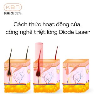 Cach-thuc-hoat-dong-cua-cong-nghe-triet-long-Diode-Laser