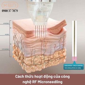 cach-thuc-hoat-dong-cua-cong-nghe-rf-microneedling