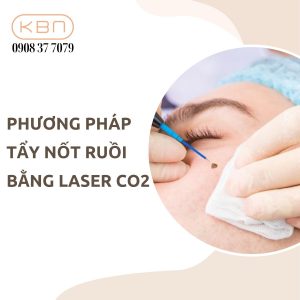 phuong-phap-tay-not-ruoi-bang-laser-co2