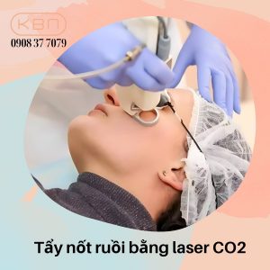 tay-not-ruoi-bang-laser-co2-bao-nhieu-tien