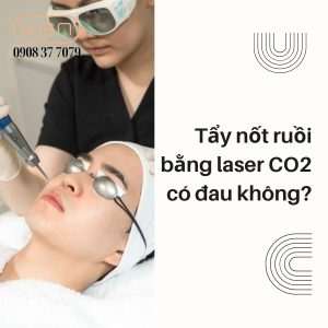 tay-not-ruoi-bang-laser-co2-co-dau-khong