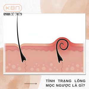 triet-long-co-bi-moc-nguoc-khong