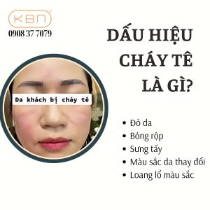 da-mat-bi-chay-te-phai-lam-sao