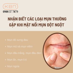 mat-dot-nhien-noi-nhieu-mun-do