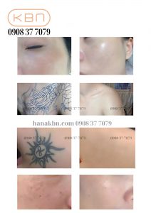 may-laser-monica-xoa-cham-xoa-bot
