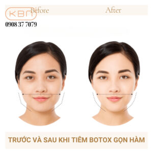 gia-tiem-botox-gon-ham