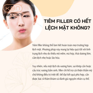 mat-lech-tiem-filler-duoc-khong