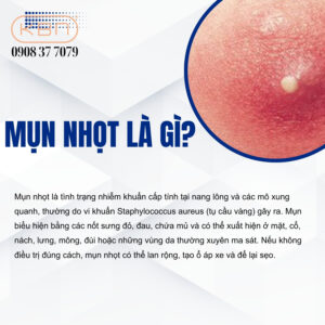 mun-nhot-la-gi