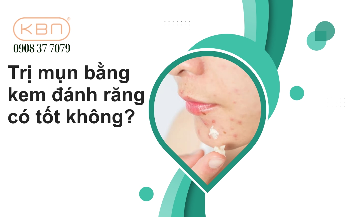 Trị mụn bằng kem đánh răng có tốt không? Có nên bôi?