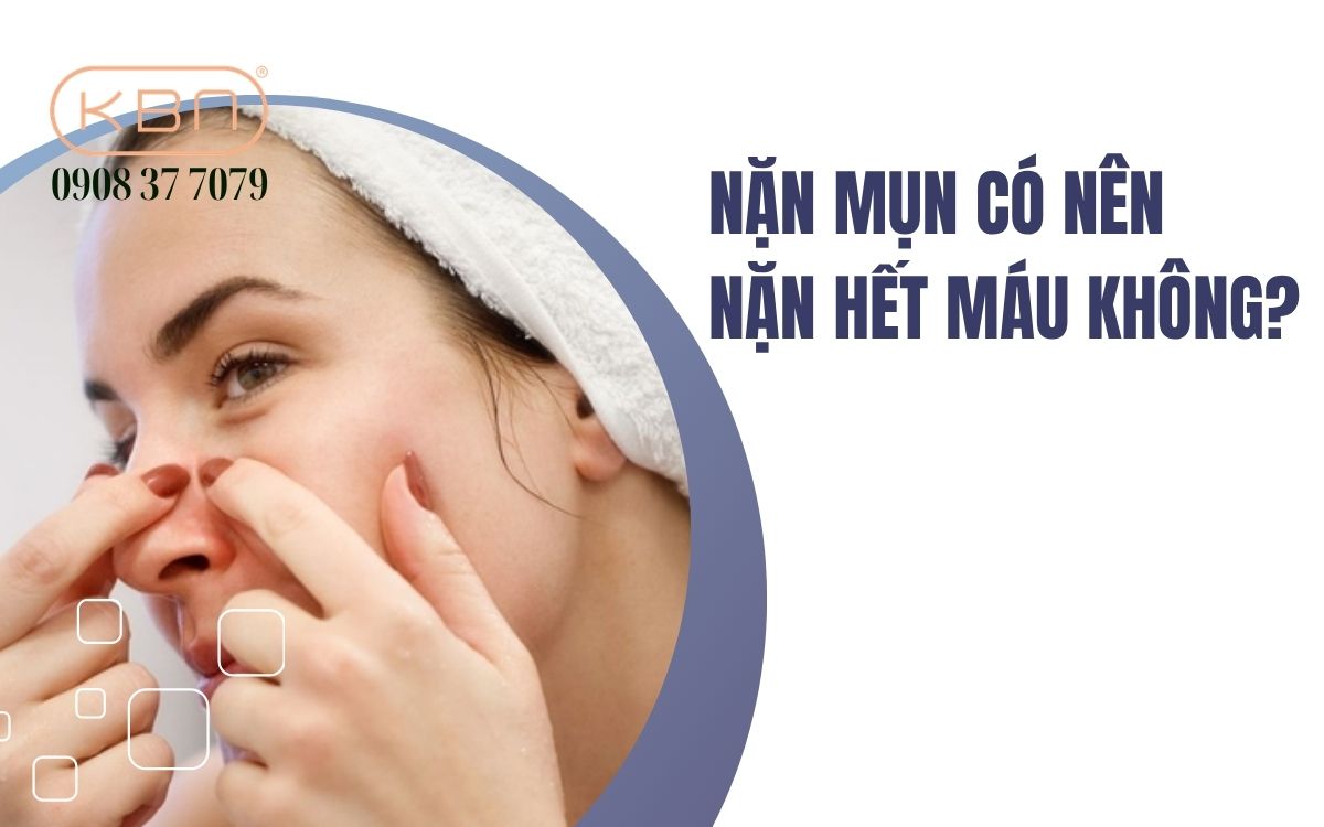Nặn mụn có nên nặn hết máu không?