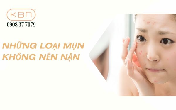 Những loại mụn không nên nặn: Nhận biết và xử lý đúng cách