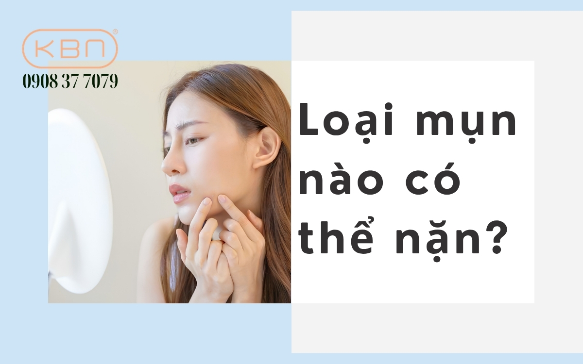 Loại mụn nào có thể nặn? Nhận biết và xử lý đúng cách